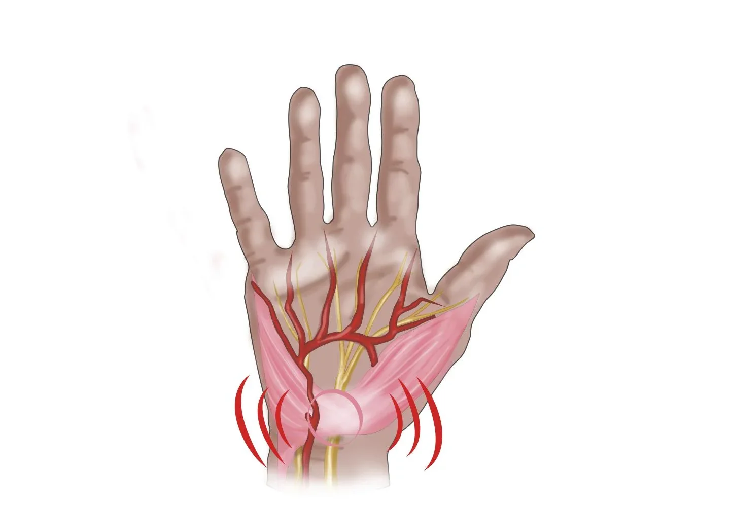 Handgelenkbandage bei Athrose und Karpaltunnel, rechts, 1 Stück - 0